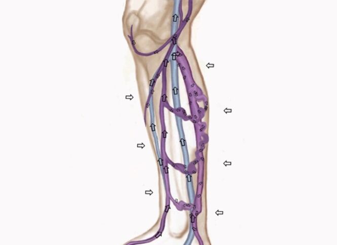 change in the direction of movement of blood with varicose veins